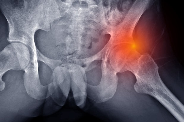 Conflit fémoro-acétabulaire (FAI) ou syndrome de conflit de la hanche