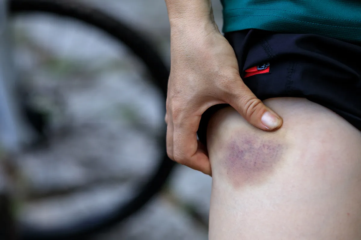 Personne avec une jambe contusionnée causée par un accident de vélo